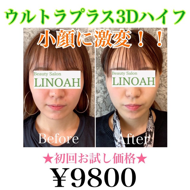 ウルトラプラス3Dハイフ＋首リンパ付き 14800円 | ブログ | 脱毛